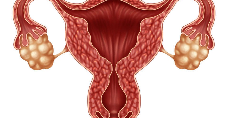 polycystic ovaries