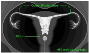 Hysterosalpingogram