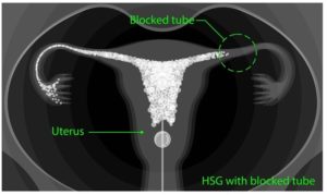 Hysterosalpingogram