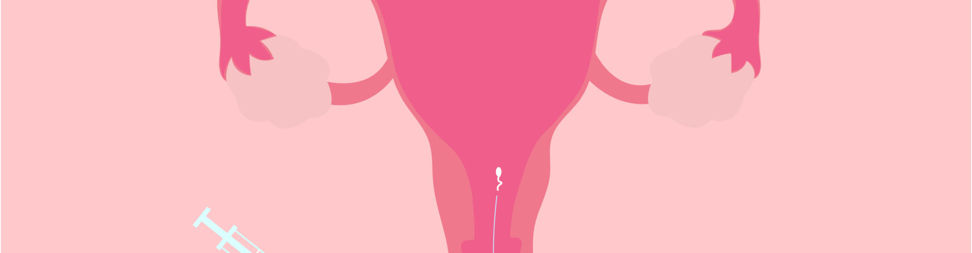 Vector illustration of intrauterine insemination (IUI)