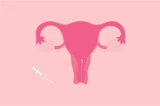 What’s the difference between IVF and IUI?