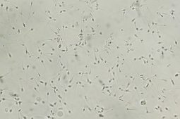 Normozoospermia analyzed by microscope. Semen analysis normal sp