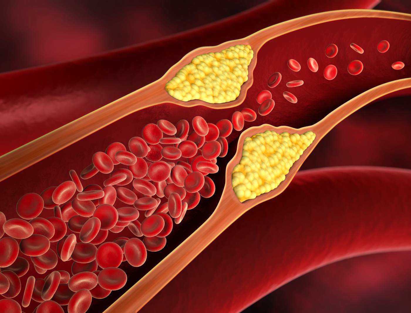 High cholesterol can affect the fertility of both men and women